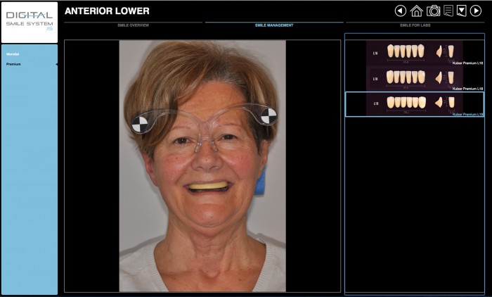 Schermata Digital Smile System che mostra la libreria del paziente anteriore e di suggerimento di immagine del basso anteriore